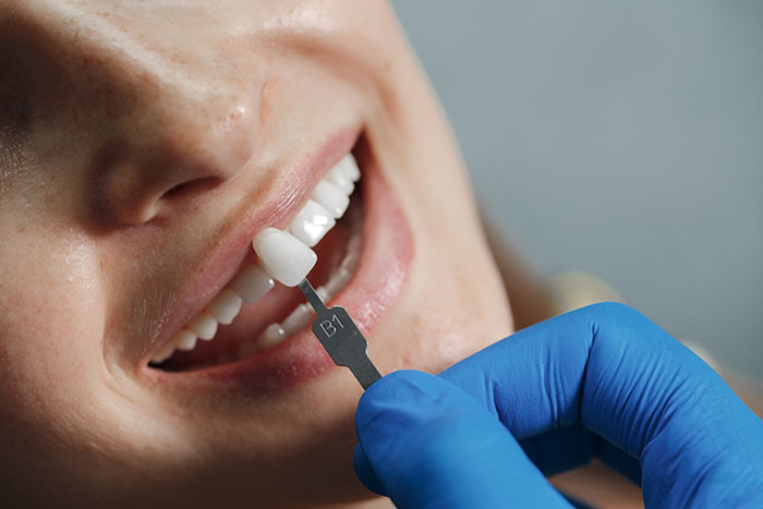 dentist-whiting-teeth Dental Crown,. Amy Dental Clinic, best doctor in USA, White