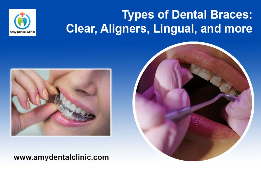 Types of Dental Braces